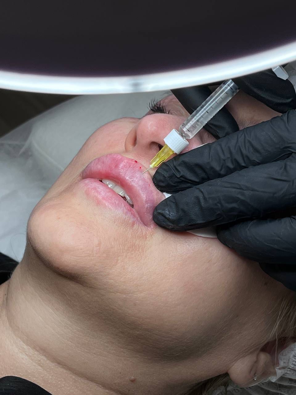 Инъекционная косметология