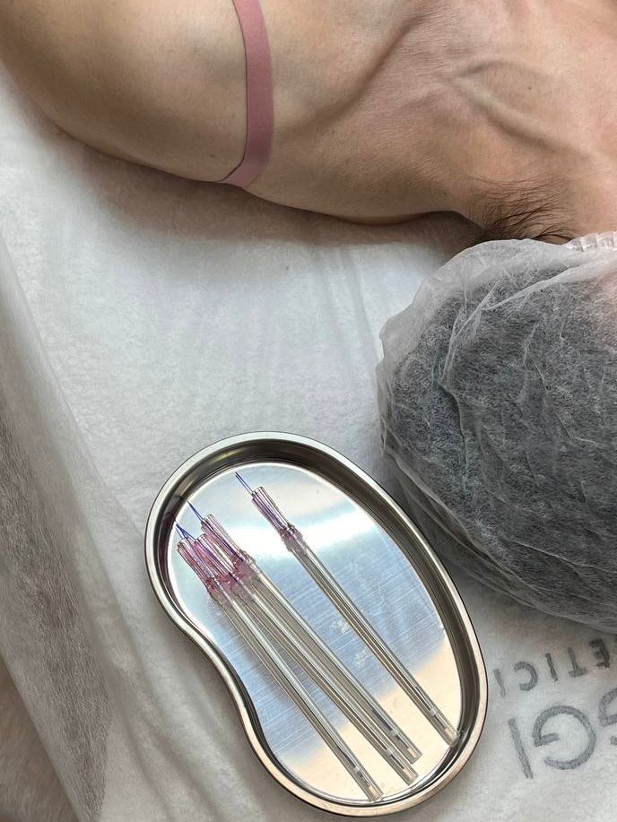 Нитевой лифтинг лица и шеи